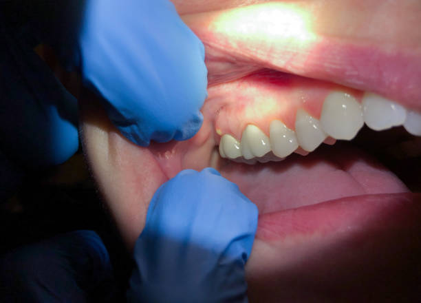 Best Broken or Cracked Tooth Emergency Dentist in Garrett, WA